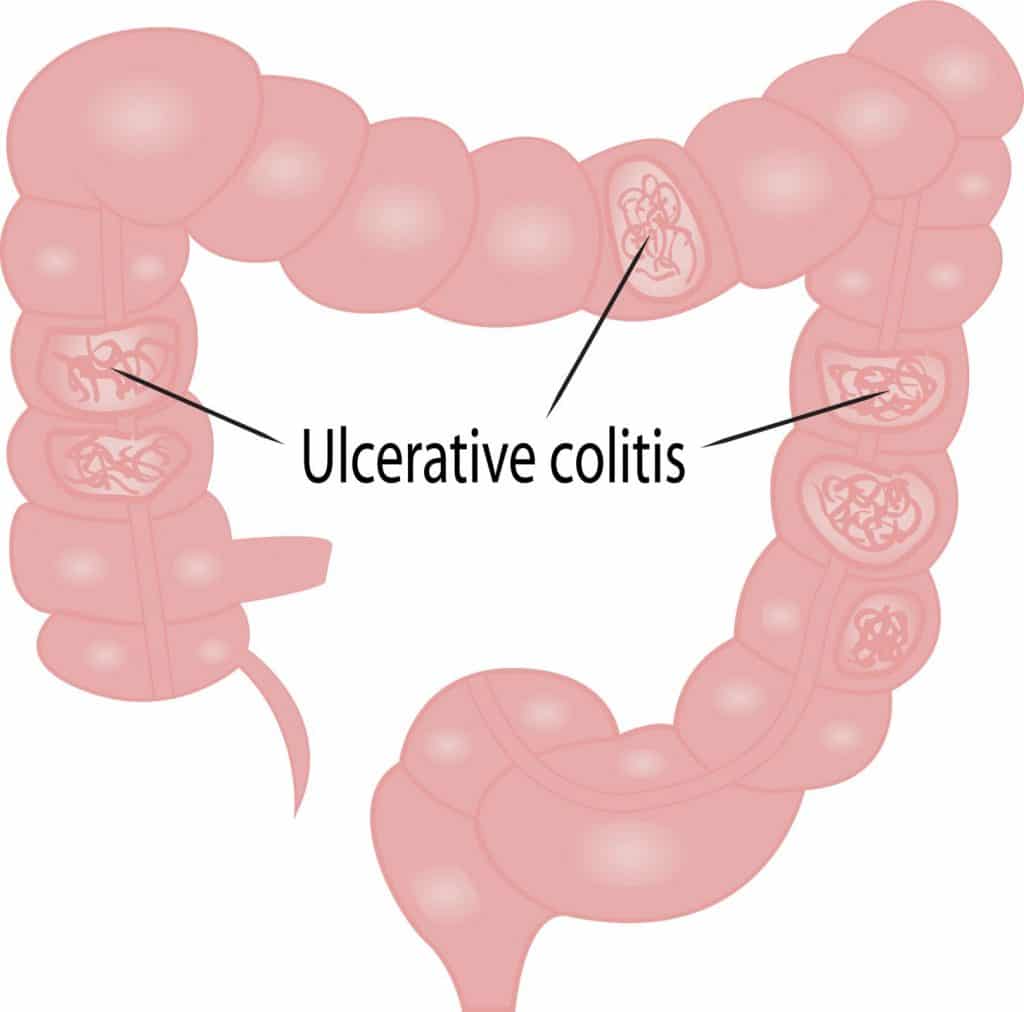 This image has an empty alt attribute; its file name is ulcerative-colitis-1024x1012.jpg